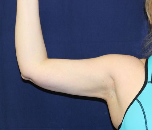 Arm Lift*/Arm Sculpting: Case 5 - After Front