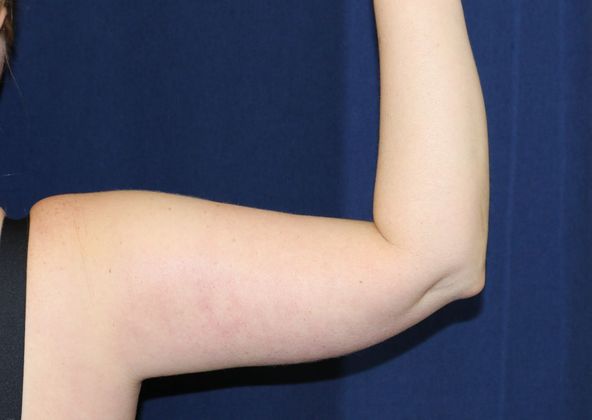 Arm Lift*/Arm Sculpting: Case 5 - Before Back