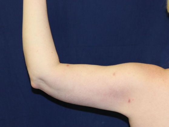 Arm Lift*/Arm Sculpting: Case 5 - After Back