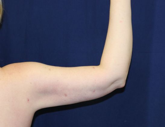 Arm Lift*/Arm Sculpting: Case 5 - After Back