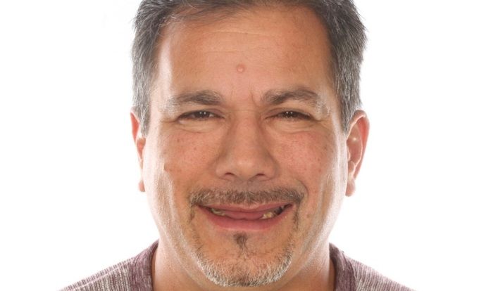 All on 4 Dental Implants Case 5  - Before