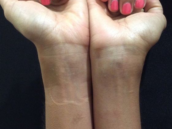 Laser Tattoo Removal Case 3 - After