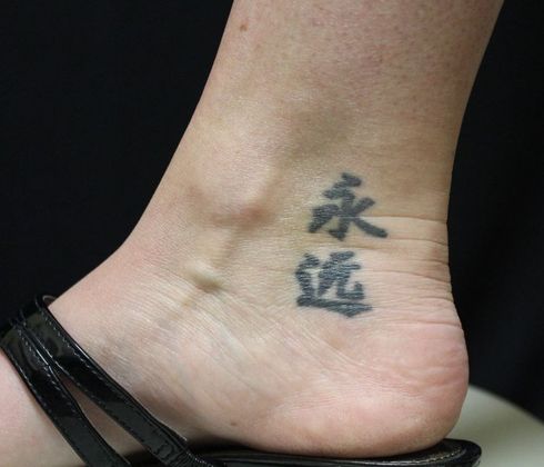 Laser Tattoo Removal Case 4 - Before