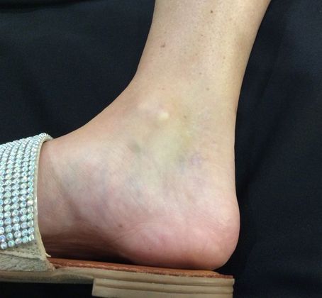 Laser Tattoo Removal Case 4 - After