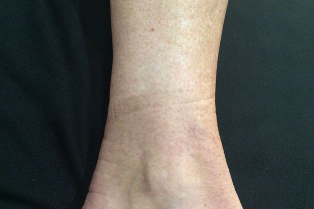 Laser Tattoo Removal Case 5 - After