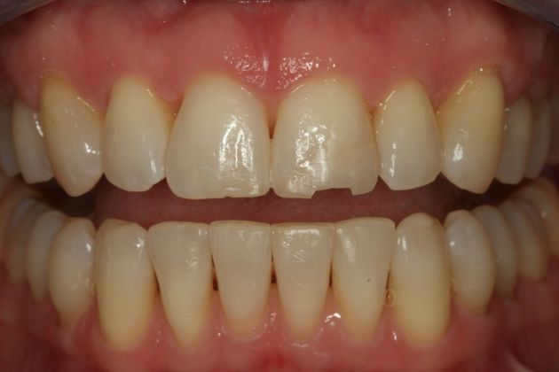 Composite Bonding: Composite Bonding - Case 1 - Before