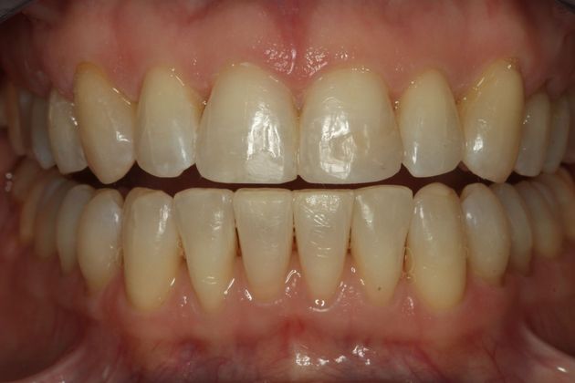 Composite Bonding: Composite Bonding - Case 1 - After