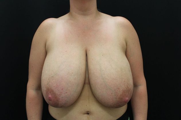 Breast Reduction Case 20 - Before