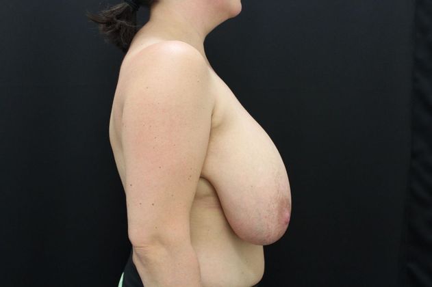 Breast Reduction: Case 20 - After