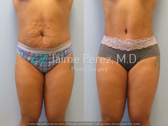 Before & After