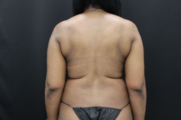 Liposuction Case 16 - Before