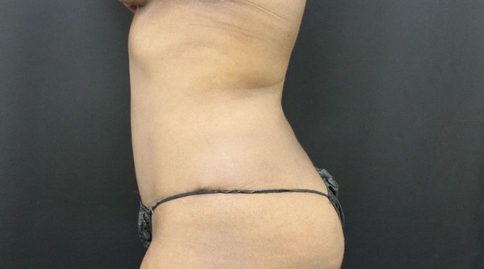 Liposuction: Case 16 - Before
