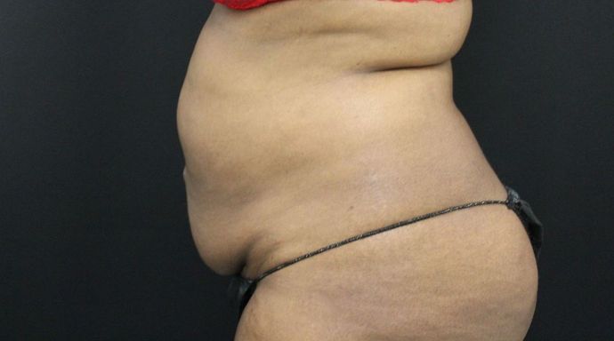 Liposuction: Case 16 - After