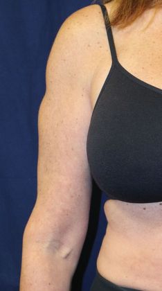 Arm Lift*/Arm Sculpting: Case 1 - After Front Marked