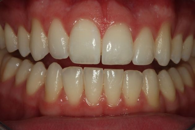 Composite Bonding: Case 2 - After