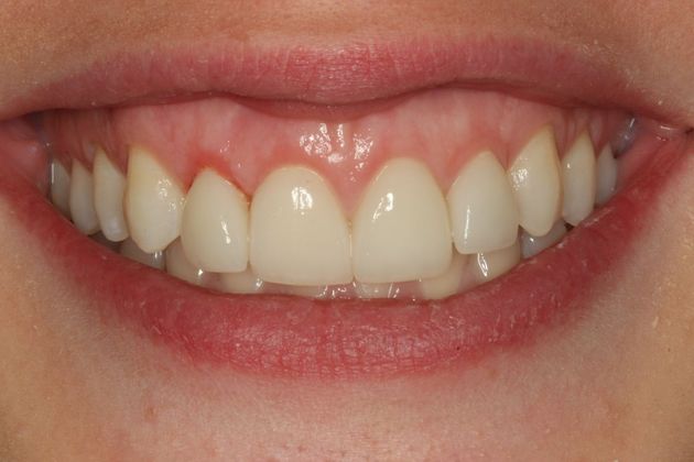 Laser Gum Reshaping Case 1 - After