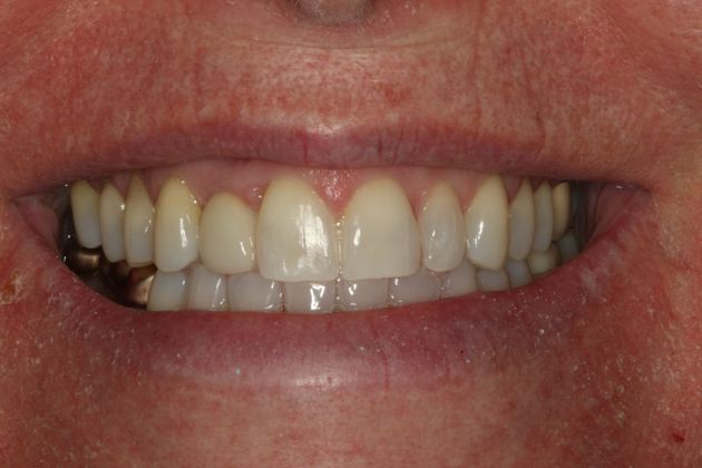 Dental Implants: Case 1 - After