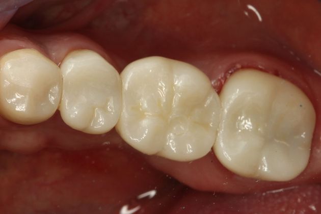Dental Implants Case 2 - After