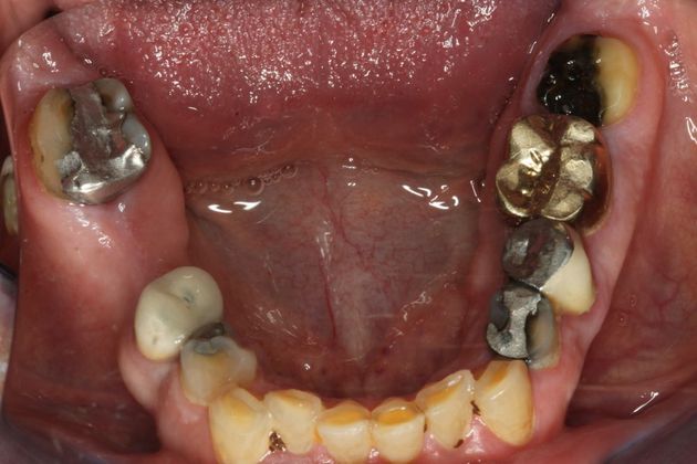 Dental Implants: Case 2 - Before