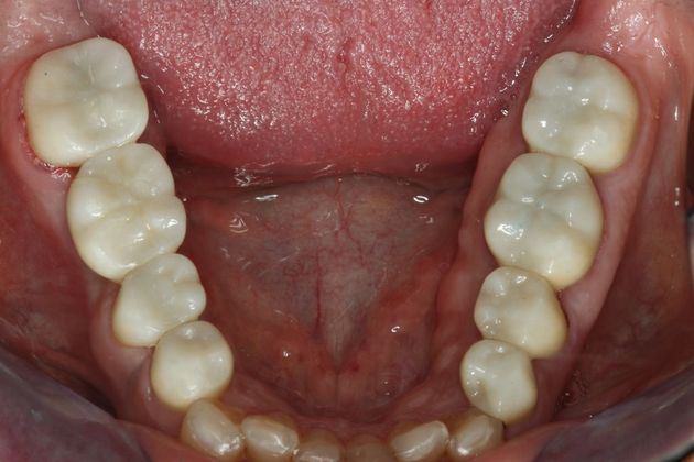 Dental Implants: Case 2 - After