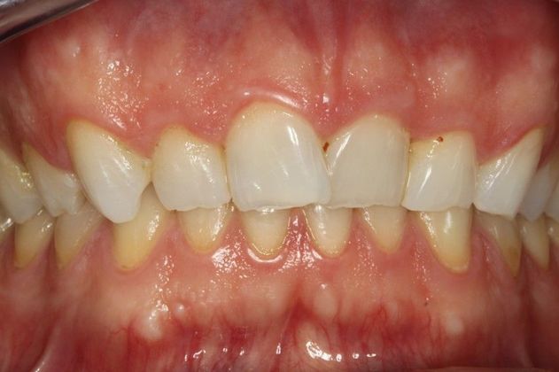 Invisalign Case 1 - Before