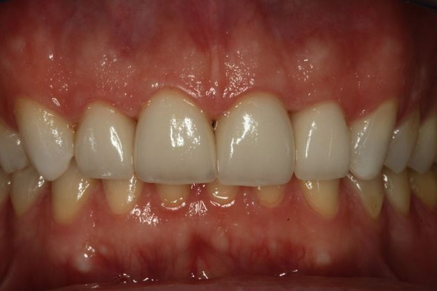 Invisalign Case 1 - After