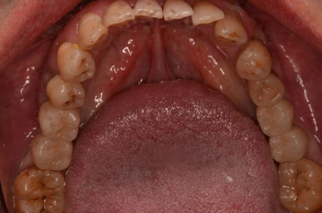 Dental Implants: Case 14 - After