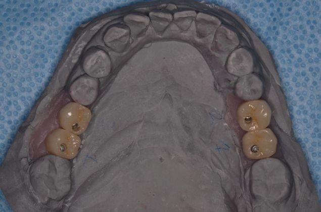 Dental Implants: Case 14 - Before