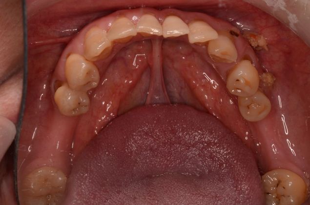 Dental Implants: Case 14 - Before