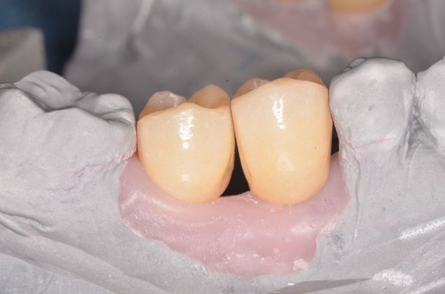 Dental Implants: Case 14 - Before