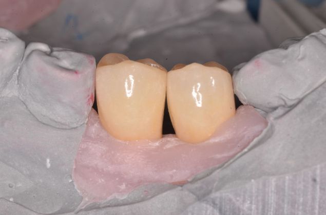 Dental Implants: Case 14 - After
