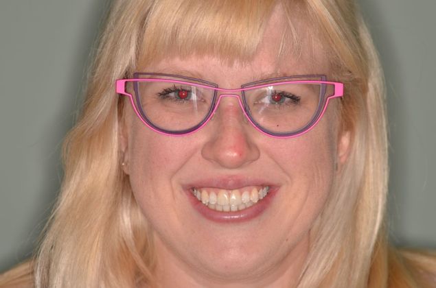 Porcelain Veneers: Case 3 - After