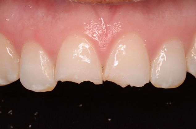 Porcelain Veneers: Case 3 - Before