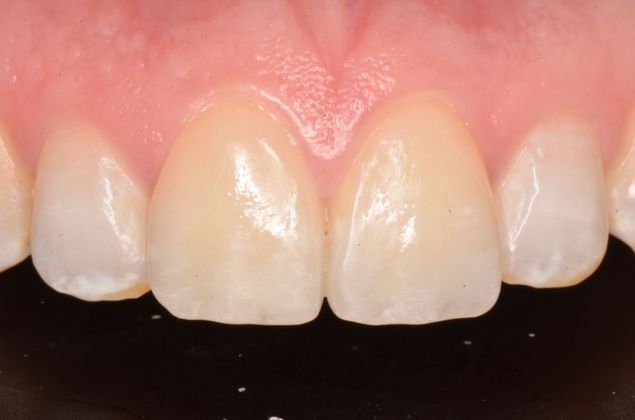 Porcelain Veneers: Case 3 - After