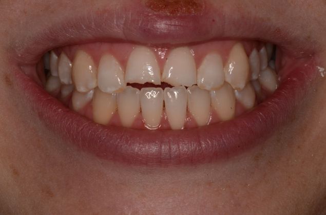 Porcelain Veneers: Case 3 - Before