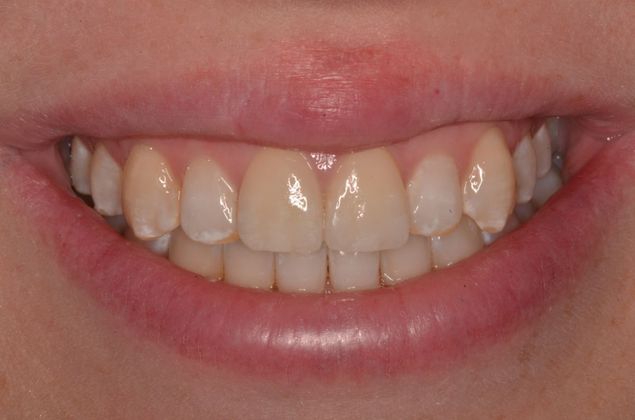 Porcelain Veneers: Case 3 - After