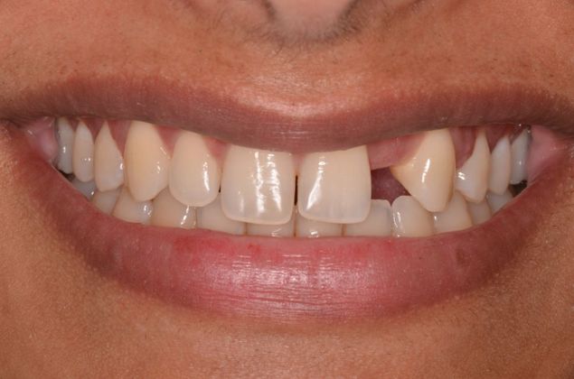 Dental Implants: Case 22 - Before