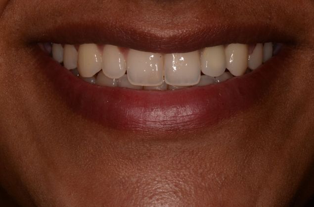 Dental Implants: Case 22 - After