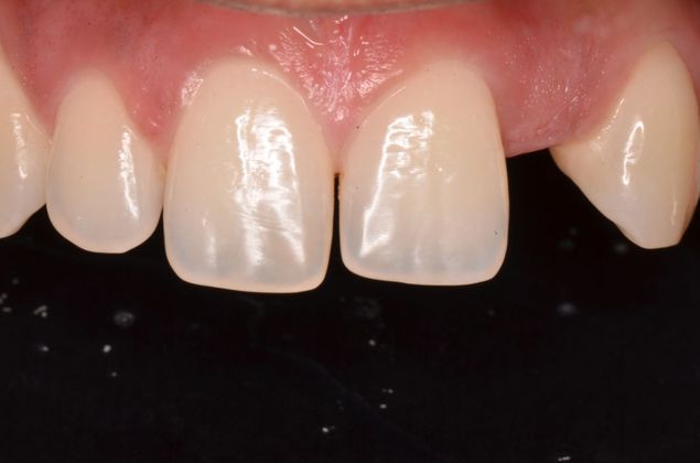 Dental Implants: Case 22 - Before