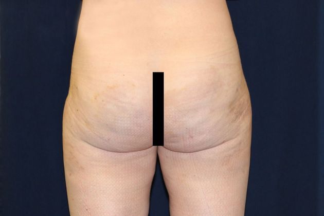 Liposuction & Safe Lipo: Case 21 - After