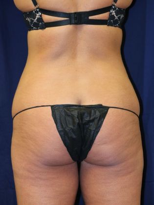 Liposuction & Safe Lipo Case 22 - Before