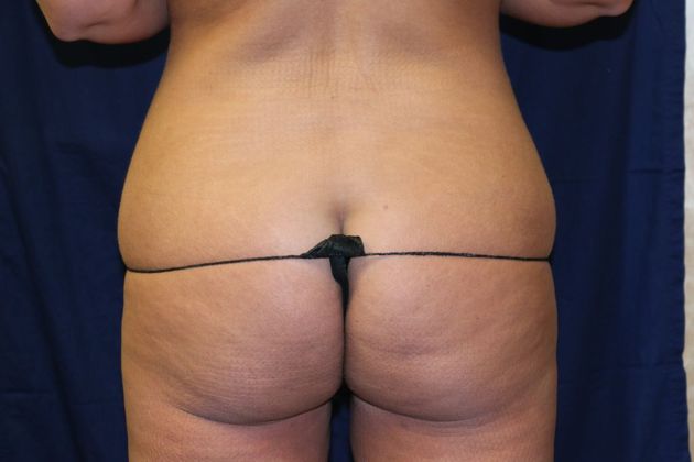 Liposuction & Safe Lipo: Case 22 - Before