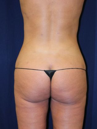 Liposuction & Safe Lipo Case 22 - After