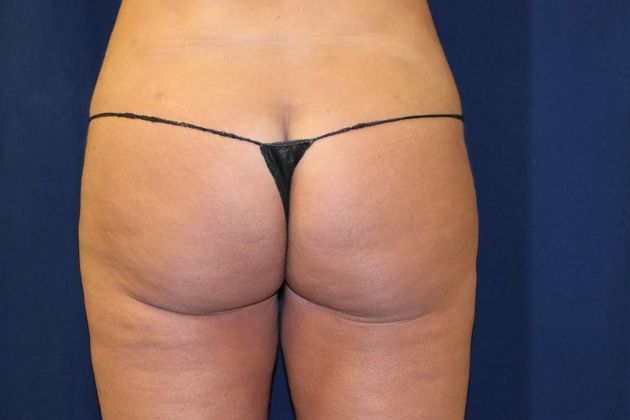 Liposuction & Safe Lipo: Case 22 - After