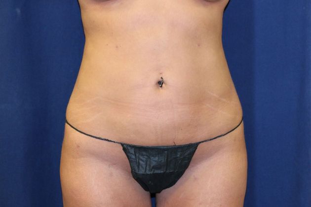 Liposuction & Safe Lipo: Case 22 - After