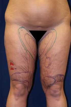 Liposuction & Safe Lipo: Case 22 - Before