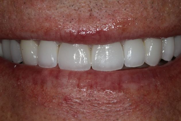 Full Mouth Rehabilitation: Scott - After