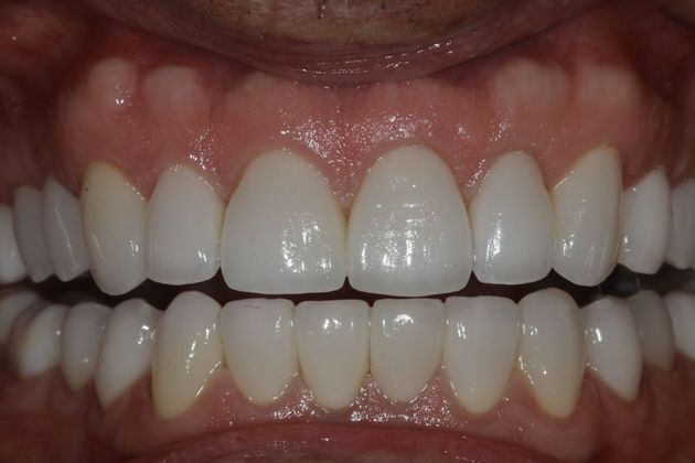 Full Mouth Rehabilitation: Scott - After