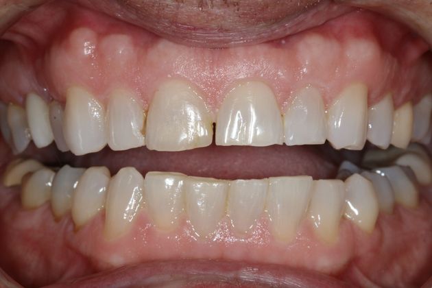 Full Mouth Rehabilitation: Scott - Before