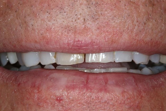 Full Mouth Rehabilitation: Scott - Before